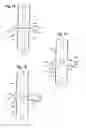 Fig. 08 - OFFSET BALLOONS FOR LUMEN SUPPORT OR DILATION