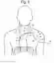 Fig. 06 - APPARATUS AND METHODS FOR ASSISTED BREATHING BY TRANSVASCULAR NERVE STIMULATION