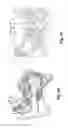 Fig. 08 - Implantable microphone for an implantable ear prosthesis