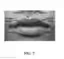 Fig. 09 - Lip-enhancement device and method