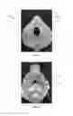 Fig. 15 - Liner for use with respiratory mask