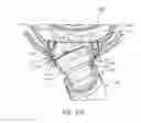 Fig. 45 - AN ELBOW ASSEMBLY OF A PATIENT INTERFACE, AN ANTI-ASPHYXIA VALVE FOR AN ELBOW ASSEMBLY AND A CONNECTOR