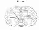 Fig. 09 - Method of Treating Traumatic Brain Injury with Red/NIR Light