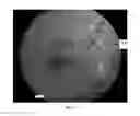 Fig. 02 - AUTOMATED BLOOD VESSEL FEATURE DETECTION AND QUANTIFICATION FOR RETINAL IMAGE GRADING AND DISEASE SCREENING