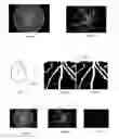 Fig. 06 - AUTOMATED BLOOD VESSEL FEATURE DETECTION AND QUANTIFICATION FOR RETINAL IMAGE GRADING AND DISEASE SCREENING