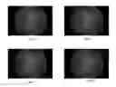 Fig. 08 - AUTOMATED BLOOD VESSEL FEATURE DETECTION AND QUANTIFICATION FOR RETINAL IMAGE GRADING AND DISEASE SCREENING