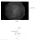 Fig. 09 - AUTOMATED BLOOD VESSEL FEATURE DETECTION AND QUANTIFICATION FOR RETINAL IMAGE GRADING AND DISEASE SCREENING