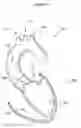 Fig. 02 - Aortic valve stent graft