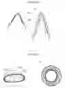 Fig. 07 - Aortic valve stent graft