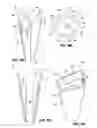 Fig. 06 - TAPERED FIXATION DEVICE FOR A KNEE REPLACEMENT