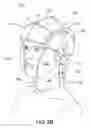 Fig. 04 - Cerebral protection system
