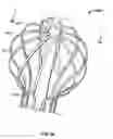 Fig. 43 - TISSUE DISPLACEMENT TOOLS AND METHODS