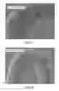Fig. 06 - Connection of a manipulation member to an endovascular intervention device