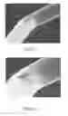 Fig. 08 - Connection of a manipulation member to an endovascular intervention device