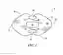 Fig. 02 - Suture button construct for surgical procedures