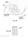Fig. 06 - Birefringent intraocular lens