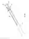 Fig. 06 - Methods, tools, and assemblies for implantation of medical leads having distal tip anchors