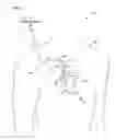 Fig. 02 - Modulate pacing rate to increase the percentage of effective ventricular capture during atrial fibrillation