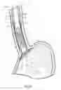 Fig. 07 - Fixation of intraluminal device