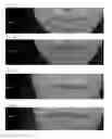 Fig. 02 - HYLA3D hyaluronic acid activating lip complex