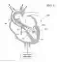 Fig. 07 - Guidable intravascular blood pump and related methods
