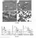 Fig. 18 - METHODS OF DIAGNOSING AND TREATING B CELL ACUTE LYMPHOBLASTIC LEUKEMIA