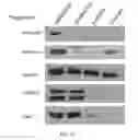 Fig. 36 - METHODS OF DIAGNOSING AND TREATING B CELL ACUTE LYMPHOBLASTIC LEUKEMIA