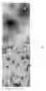 Fig. 04 - Method for predicting recurrence and progression of urothelial cancer patient after treatment