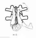 Fig. 09 - Cervical spinous process staple