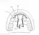 Fig. 02 - Palate anchorage device for orthodontics