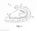 Fig. 02 - Arch expanding appliance