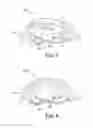 Fig. 06 - Arch expanding appliance