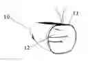 Fig. 01 - Back-up colostomy bag