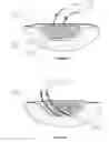 Fig. 22 - APPARATUS FOR ASPIRATING, IRRIGATING AND CLEANSING WOUNDS