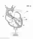 Fig. 07 - Guidable intravascular blood pump and related methods