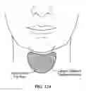 Fig. 131 - Systems, devices and methods for fractional resection, fractional skin grafting, fractional scar reduction and fractional tattoo removal