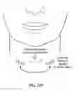 Fig. 136 - Systems, devices and methods for fractional resection, fractional skin grafting, fractional scar reduction and fractional tattoo removal
