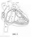 Fig. 02 - Interventional medical devices, device systems, and fixation components thereof