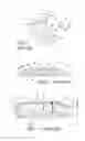 Fig. 02 - MAGNET REMOVAL AND REPLACEMENT APPARATUS AND METHODS FOR USE WITH COCHLEAR IMPLANTS