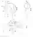 Fig. 02 - Neurostimulation titration utilizing T-wave alternans