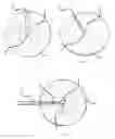 Fig. 02 - Apparatus and method for reliable attachment to chain-link fences and the like