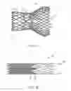 Fig. 02 - System and method of stepped deployment of prosthetic heart valve