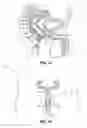 Fig. 09 - Immobilization Device for Radiation Treatment