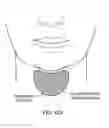 Fig. 131 - Systems, devices and methods for fractional resection, fractional skin grafting, fractional scar reduction and fractional tattoo removal