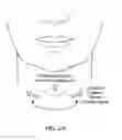 Fig. 136 - Systems, devices and methods for fractional resection, fractional skin grafting, fractional scar reduction and fractional tattoo removal