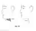 Fig. 85 - Systems, devices and methods for fractional resection, fractional skin grafting, fractional scar reduction and fractional tattoo removal
