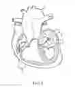 Fig. 02 - SENSOR ASSEMBLY TETHERED WITHIN CATHETER WALL