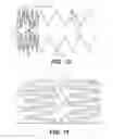 Fig. 07 - Non-foreshortening stent