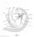 Fig. 02 - Sequentially deployed transcatheter mitral valve prosthesis