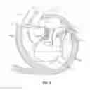Fig. 04 - Sequentially deployed transcatheter mitral valve prosthesis